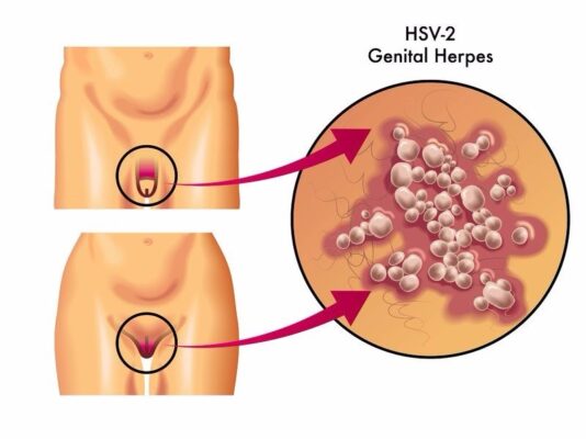 Aciclovir for Genital Herpes