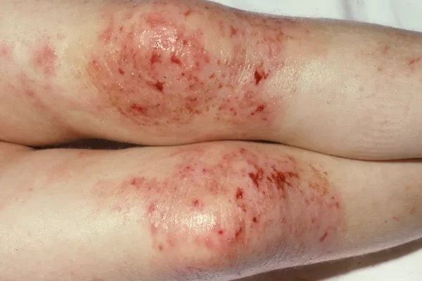 Eczema Scars