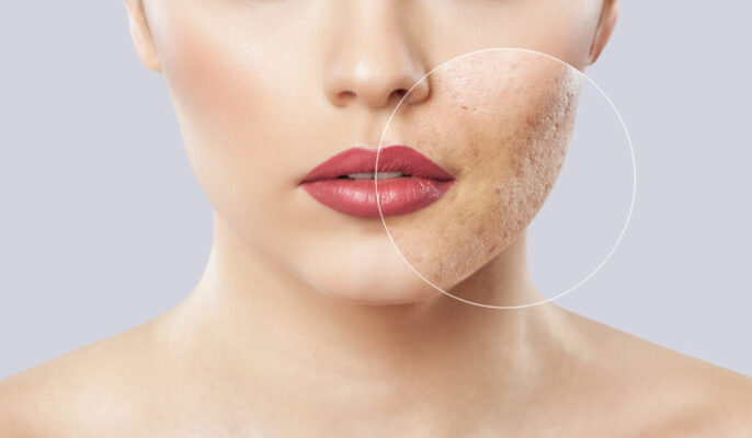 Everything You Want to Know About Acne