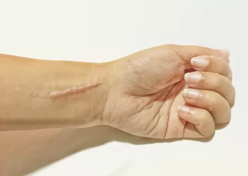 Hypertrophic scar
