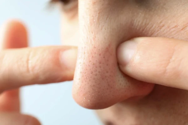 Blackheads