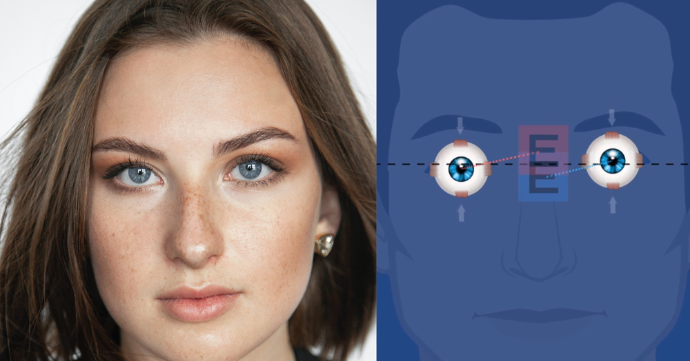 Binocular Vision Dysfunction What You Should Know MedsBase