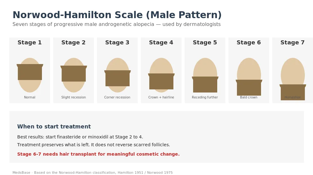 Norwood-Hamilton scale of male pattern hair loss showing seven stages of progression