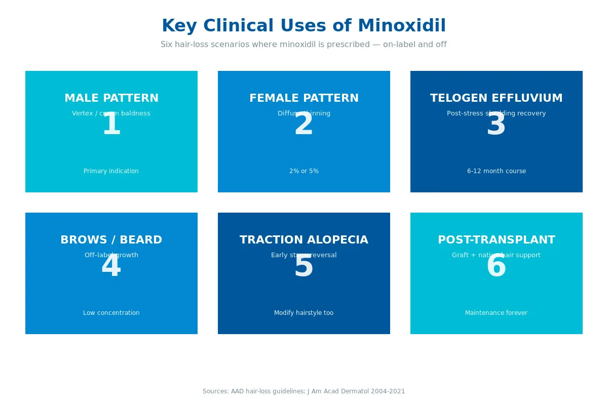 Minoxidil key uses infographic hair loss types and treatment indications