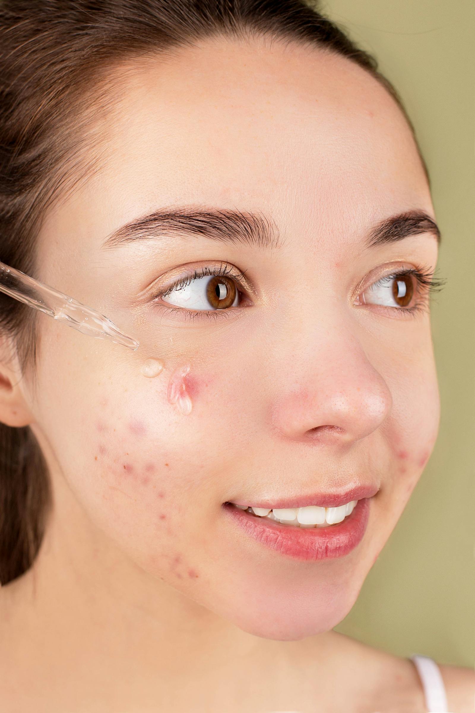 Young woman with acne applying topical treatment — tretinoin gel commonly used for inflammatory acne
