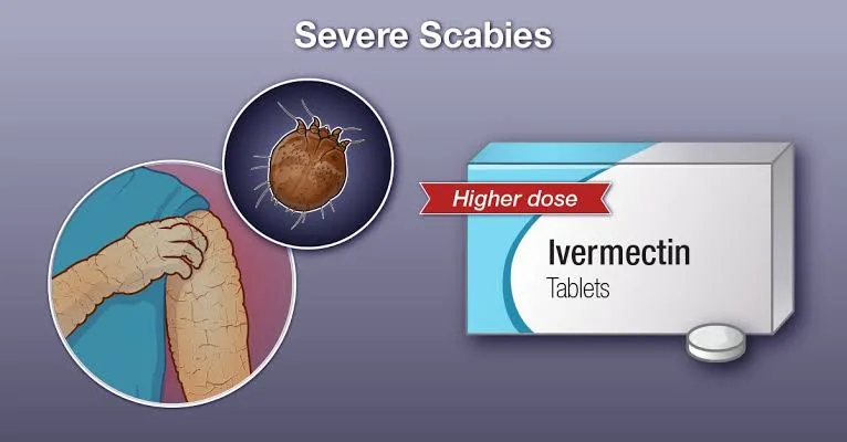 Ivermectin for Scabies