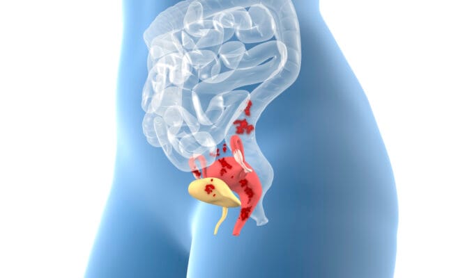 Primolut N (Norethisterone) Period Delay, Endometriosis & Menorrhagia Uses Explained