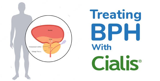Tadalafil bph cialis