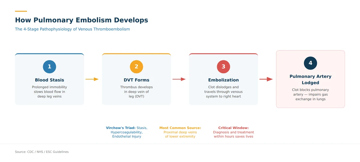 How deep vein thrombosis leads to pulmonary embolism — blood clot travels from leg to lung
